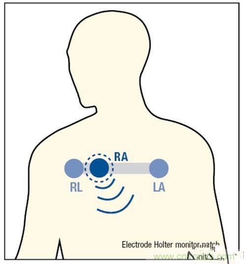 解析：一款可穿戴無線ECG動態(tài)心電監(jiān)護(hù)儀的設(shè)計